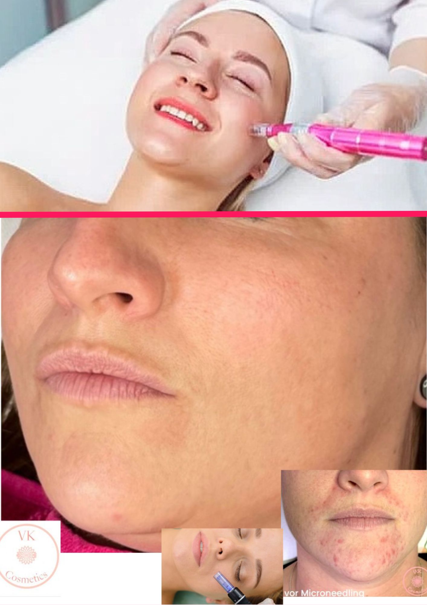Microneedling